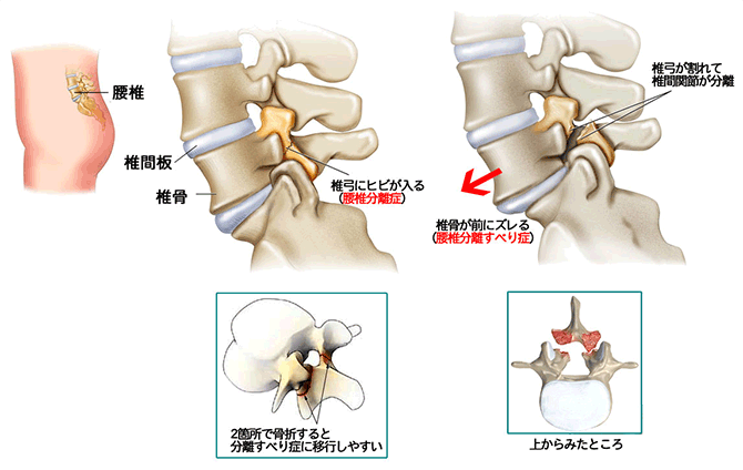 腰椎分離・辷り症