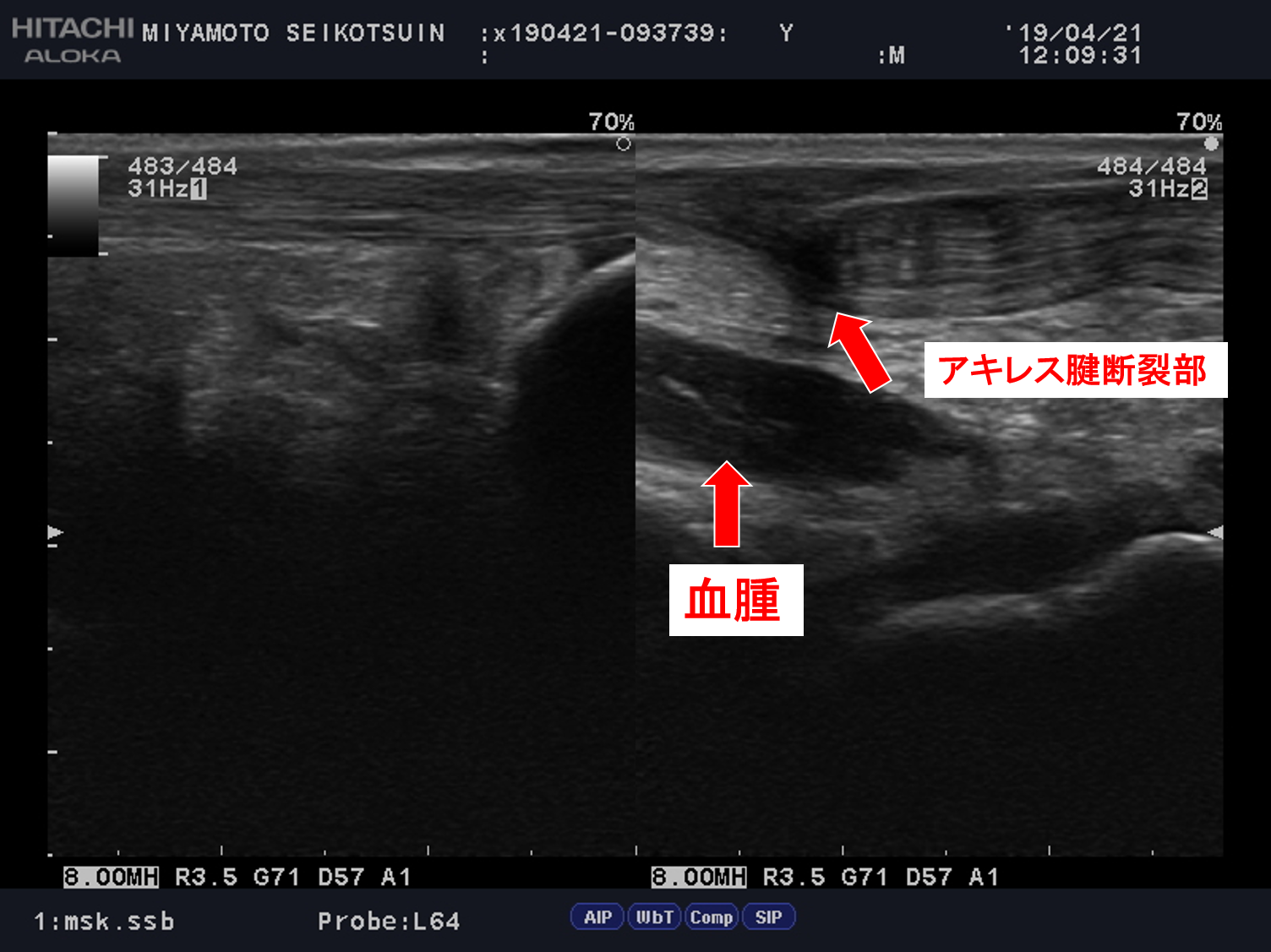 腓骨裂離骨折